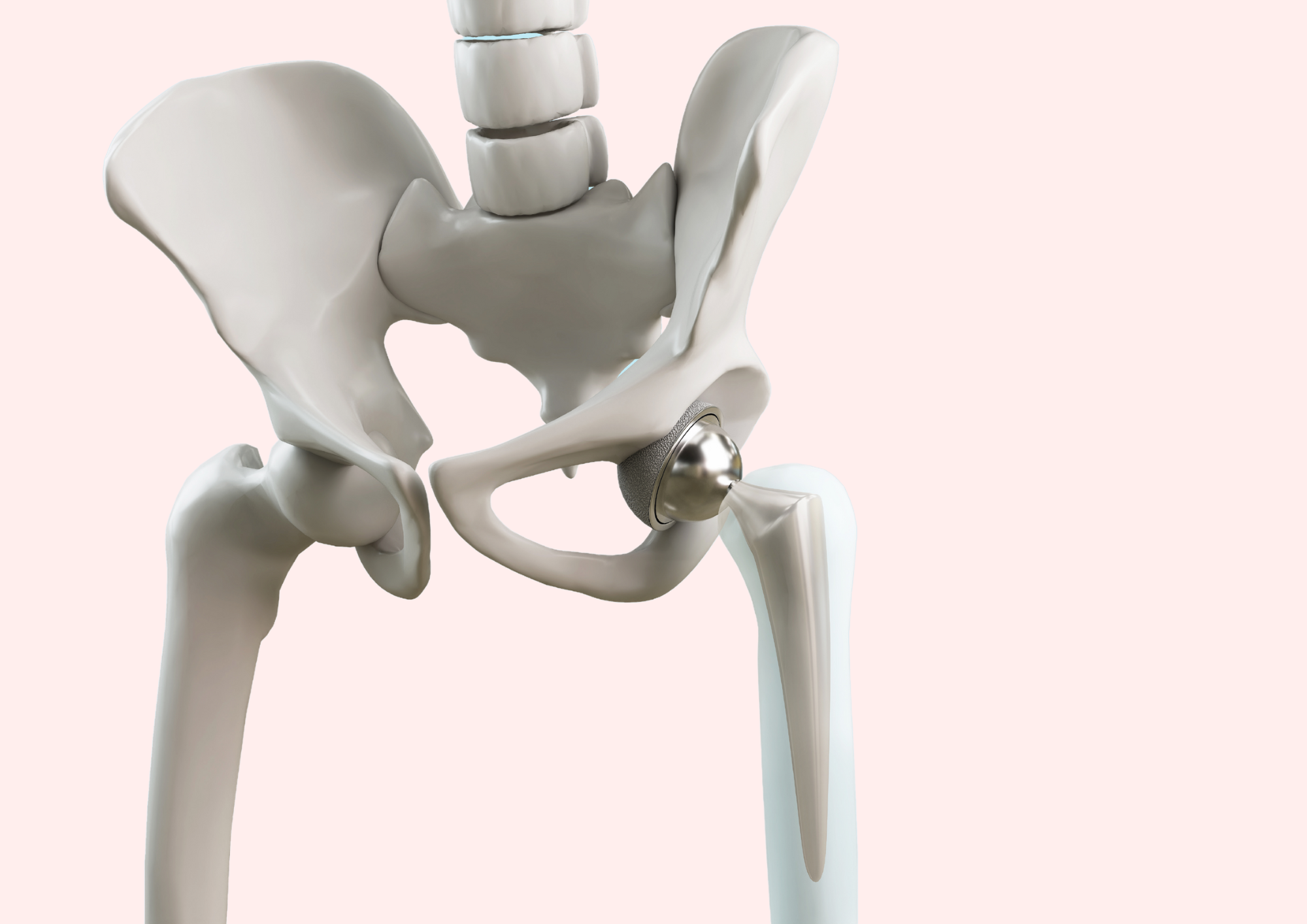 Artificial hip joint.